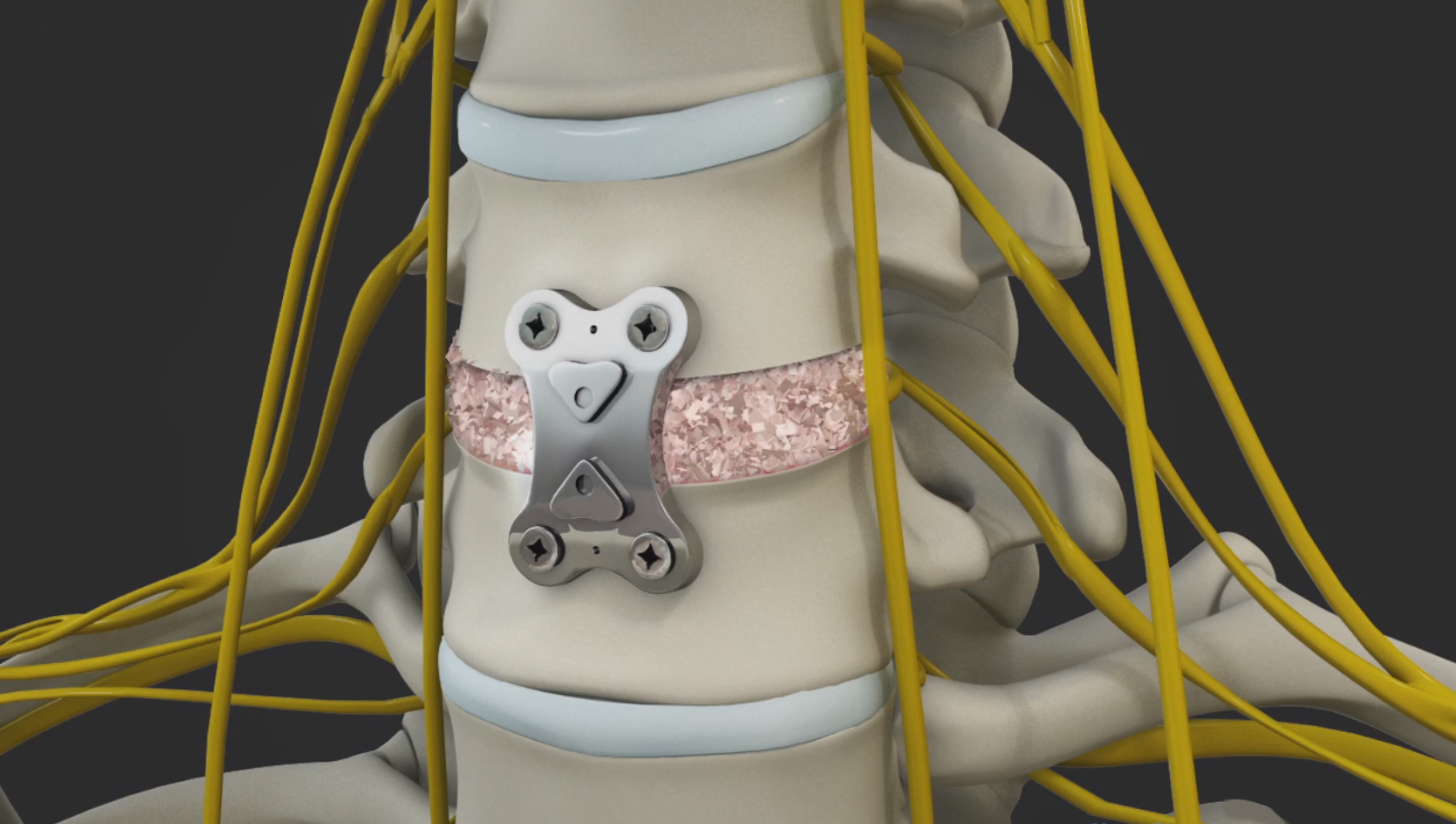 Anterior Cervical Discectomy Images