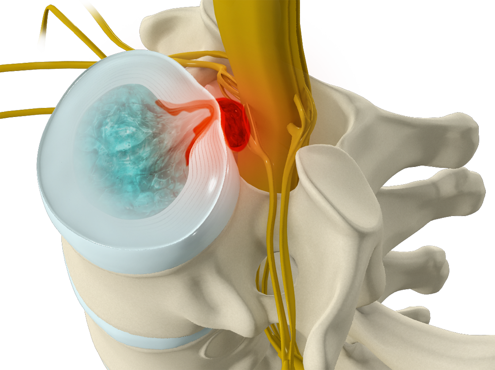 Cauda Equina Syndrome Images