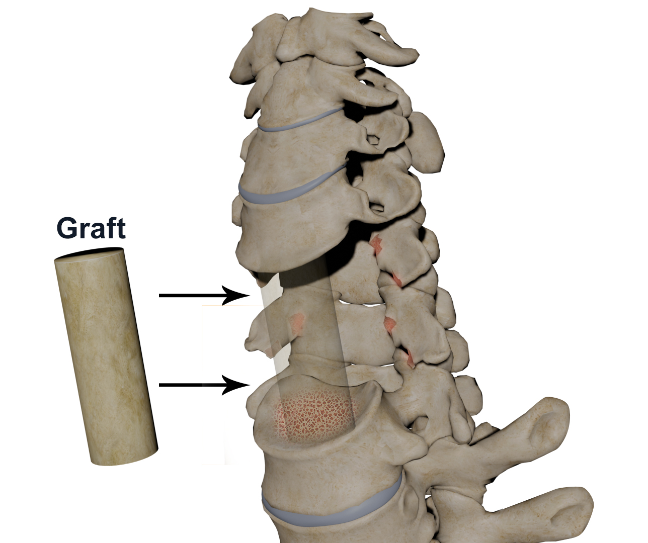 Cervical Corpectomy and Strut Graft Images