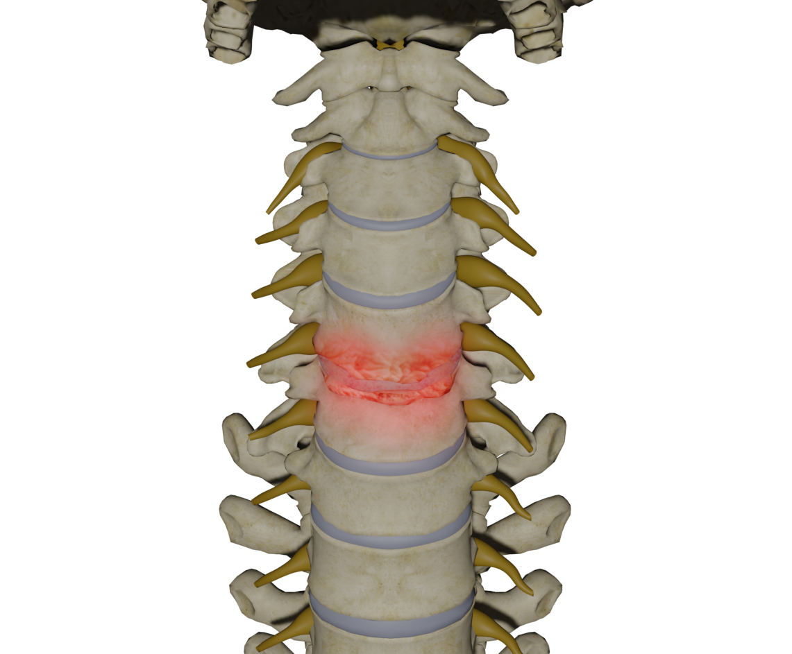 Cervical Degenerative Disorder Images