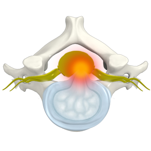 Cervical Disc Protrusion Images