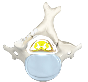 Cervical Laminoplasty Images