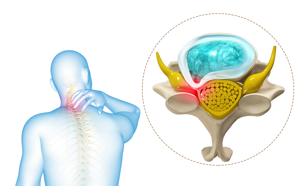 Cervical Radiculopathy/Myelopathy Images
