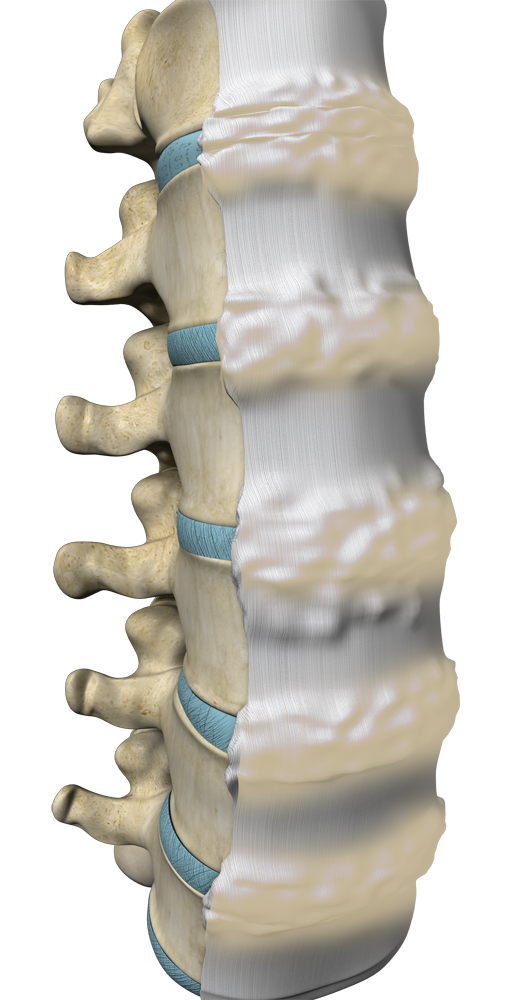 DISH (Diffuse Iliopathic Skeletal Hyperostosis) Images