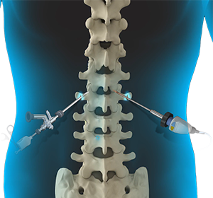 Endoscopic Spine Surgery Images