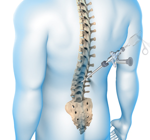 Minimally Invasive Spine Surgery Images