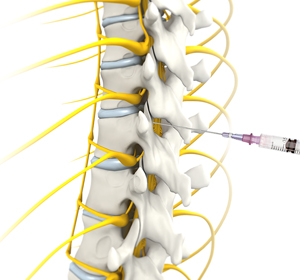 Epidural Steroid Injections Images