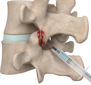 Facet Injections Images