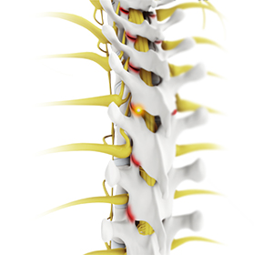 Facet joint Arthritis Images