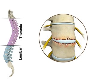 Fracture of the Thoracic and Lumbar Spine Images