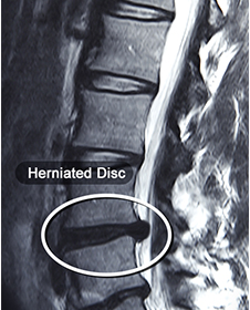 Herniated Disc Images