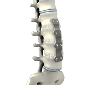 Lumbar Corpectomy and Fusion Images