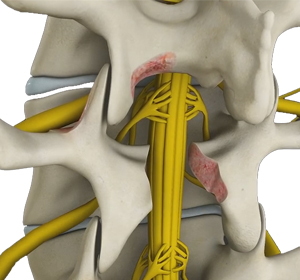 Lumbar Decompression Images