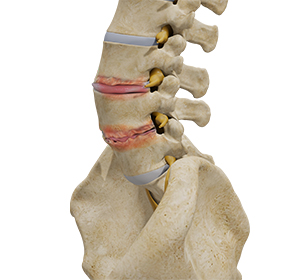 Lumbar Degenerative Disc Disease Images