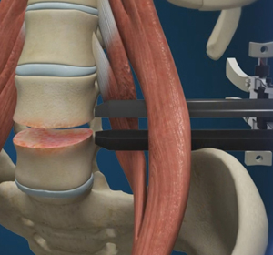 Lumbar Discectomy Images