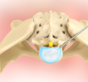 Lumbar Endoscopic Discectomy Images