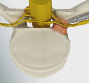 Lumbar Foraminotomy, Facetectomy Images