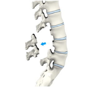 Lumbar and Cervical Laminectomy Images