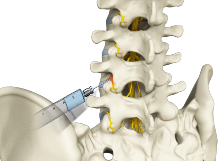Lumbar Spinal Injections Images