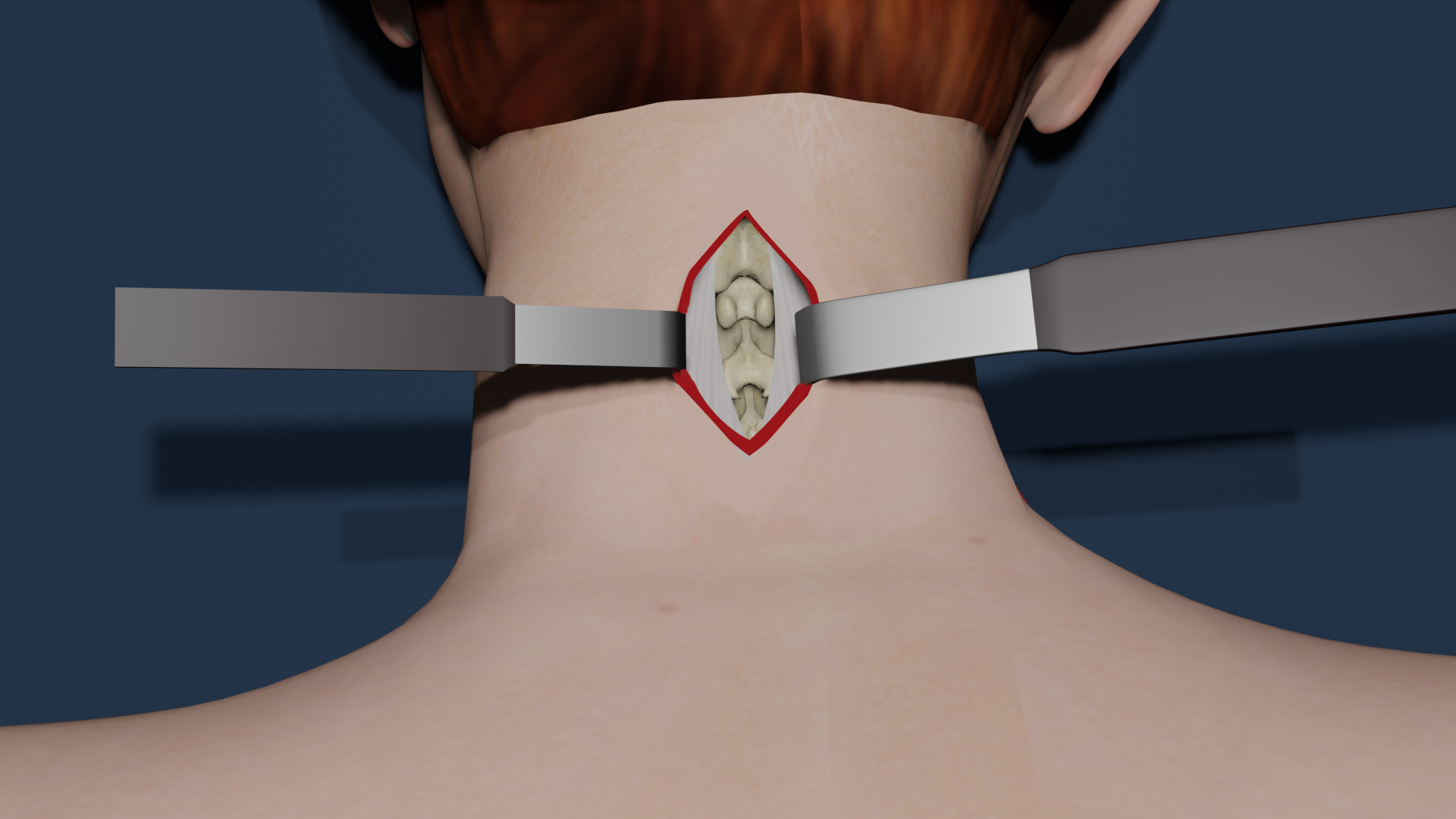 Minimally Invasive Cervical Discectomy Images