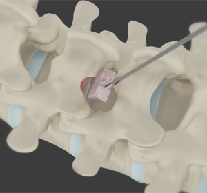 Minimally Invasive Lumbar Discectomy Images