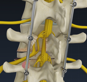 Minimally Invasive TLIF Images