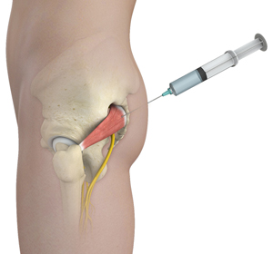 Piriformis Muscle Injection  Images