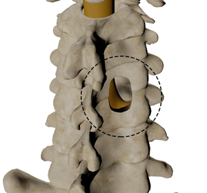 Posterior Cervical Foraminotomy Images