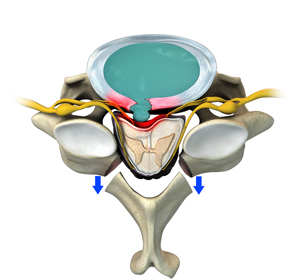 Posterior Cervical Laminectomy and Fusion Images
