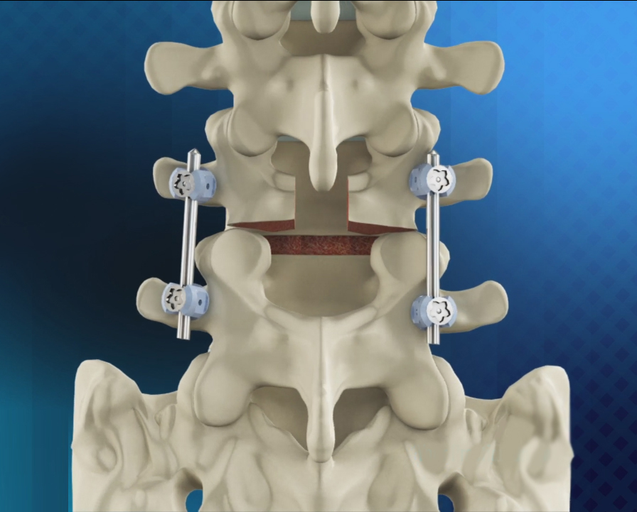 Posterior Lumbar Fusion Images