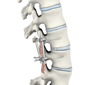 Posterior Lumbar Interbody Fusion Images