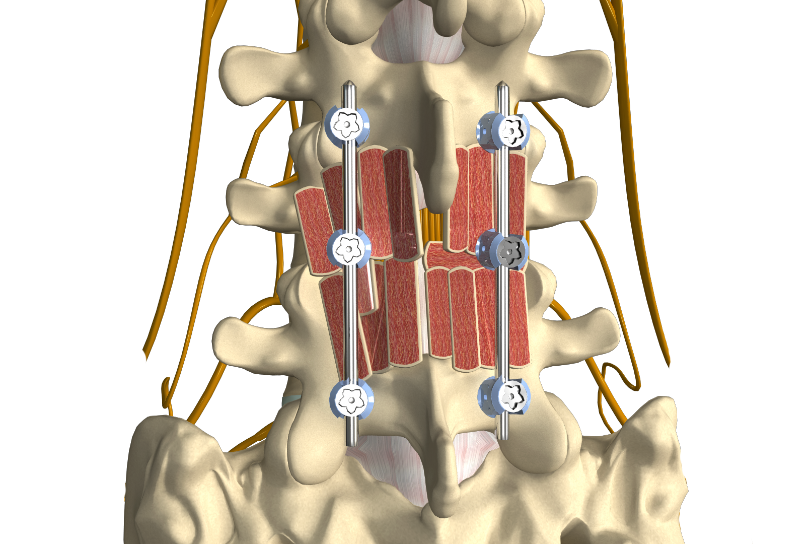 Posterolateral Lumbar Fusion Images