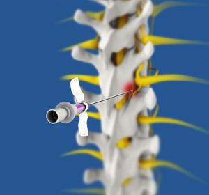 Radiofrequency Ablation Images