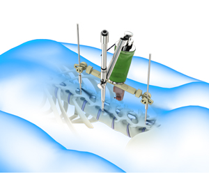 Robotic Spine Surgery Images