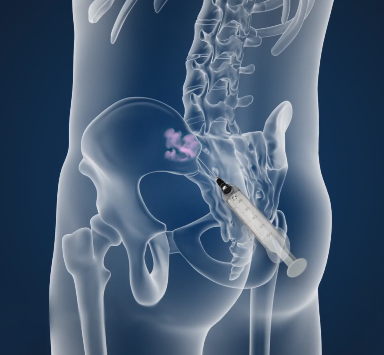 Sacroiliac Joint Injections Images