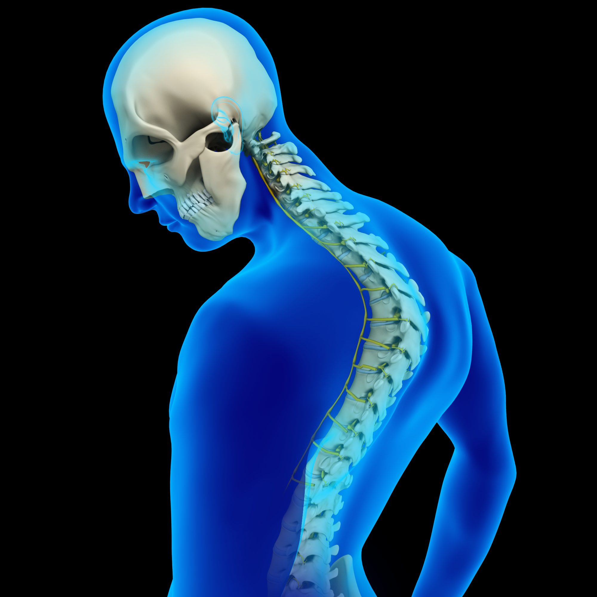 Scheuermann’s Disease Images