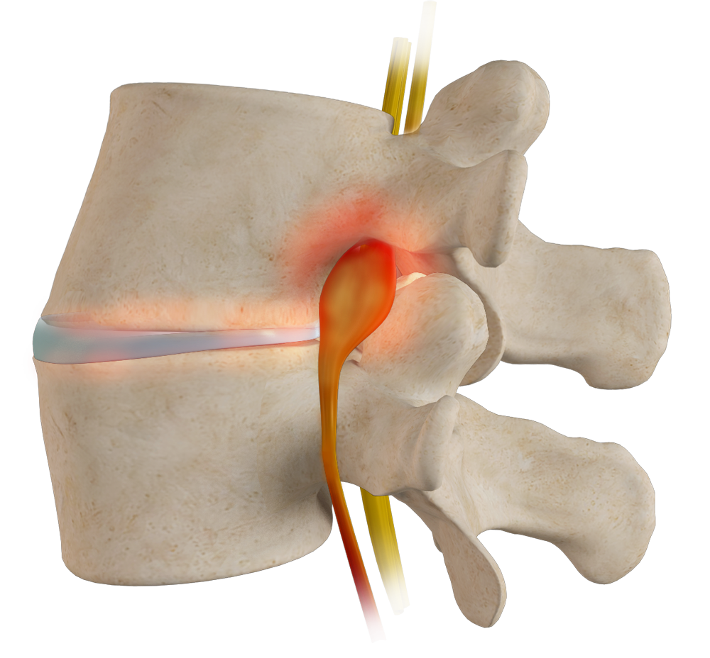 Spine Stenosis Images