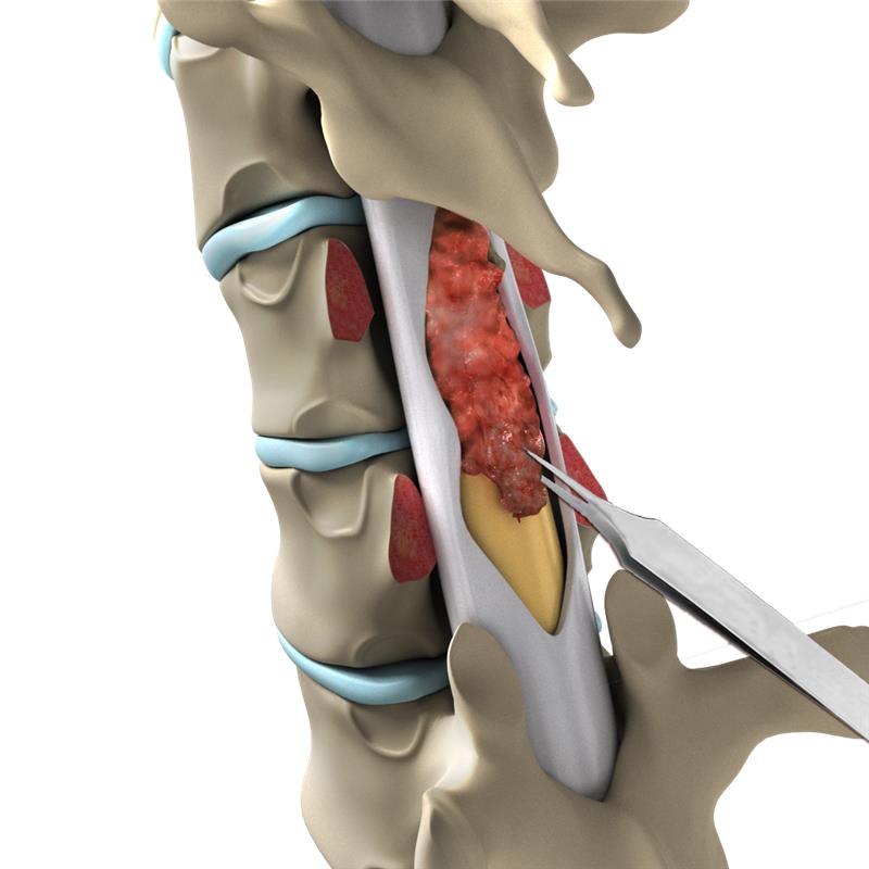 Spine Tumour Surgery Images