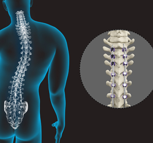 Spine Deformity Surgery Images