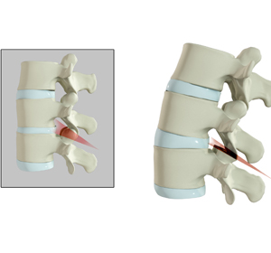 Spine Osteotomy Images