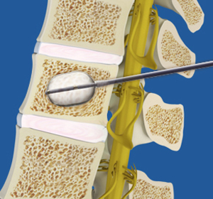 Thoracic Kyphoplasty Images