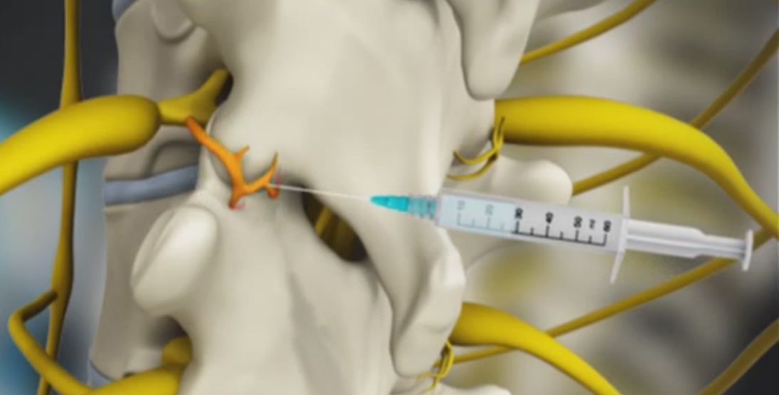 Thoracic Spinal Injections Images