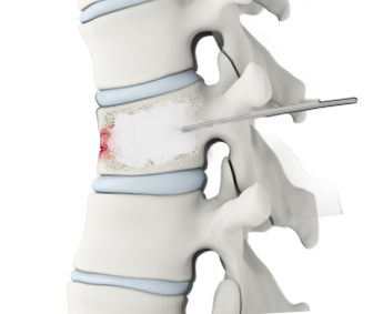 Vertebroplasty Images