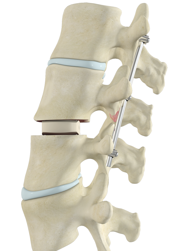 Transforaminal Lumbar Interbody Fusion Images