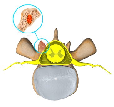 Spinal Tumours Images