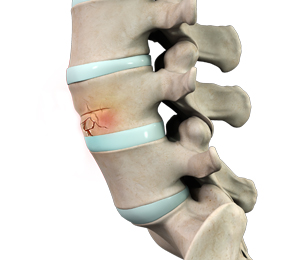 Vertebral Compression Fractures Images